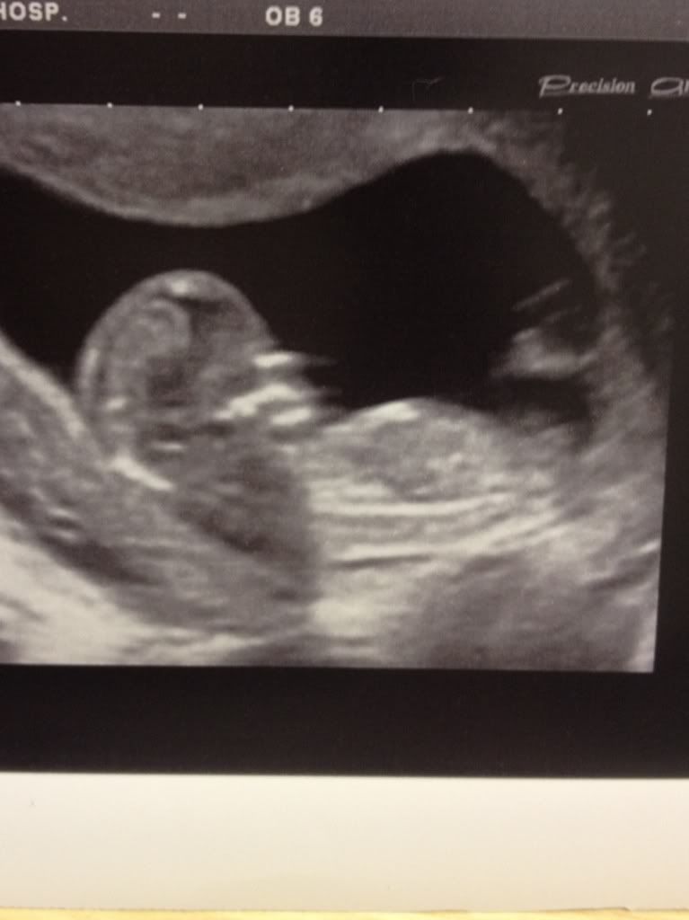 Fork nub shot girl or boy??? BabyCentre