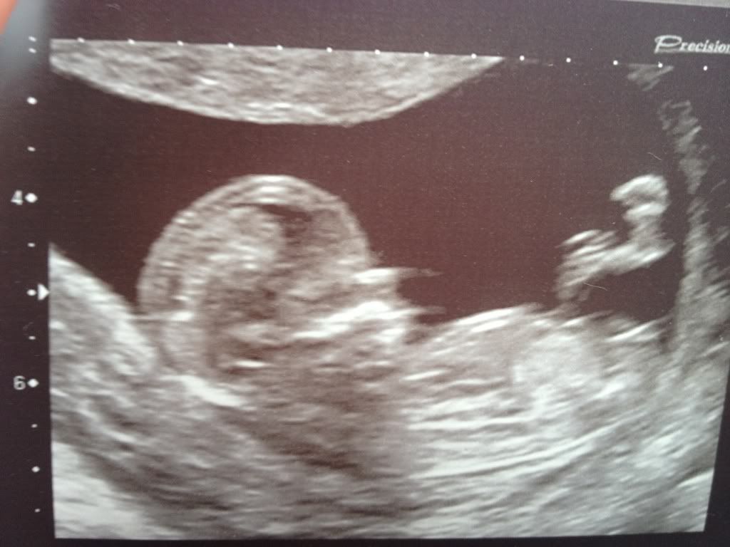 Fork nub shot girl or boy??? BabyCentre